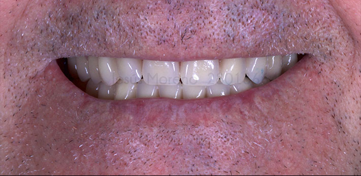 Foto posterior al Cambio total con implantes dentales en organ dental 