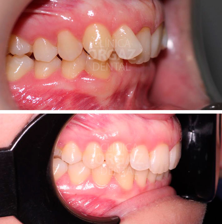 VISTA lateral antes y después del tratamiento de ortodoncia invisible