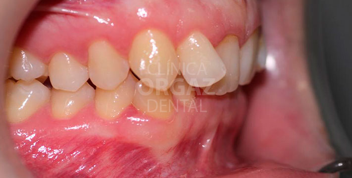 foto lateral problema de apiñamiento en ortodoncia