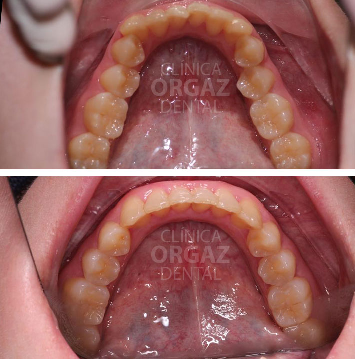 montaje fotográfico comparativa antes y después para solucionar apiñamiento severo con ortodoncia invisible.jpg.jpg
