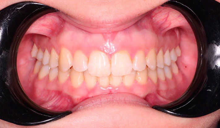 resultado perfecto tratamiento ortodoncia invisible