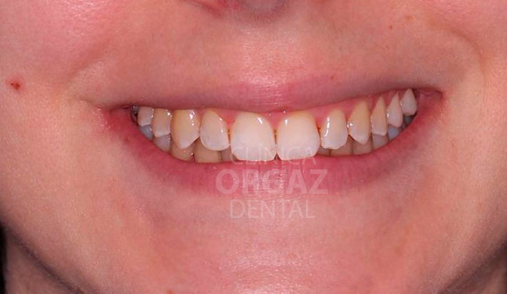 sonrisa final tratamiento ortodoncia invisible