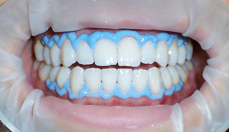 Blanqueamiento dental es seguro cuándo recomendable