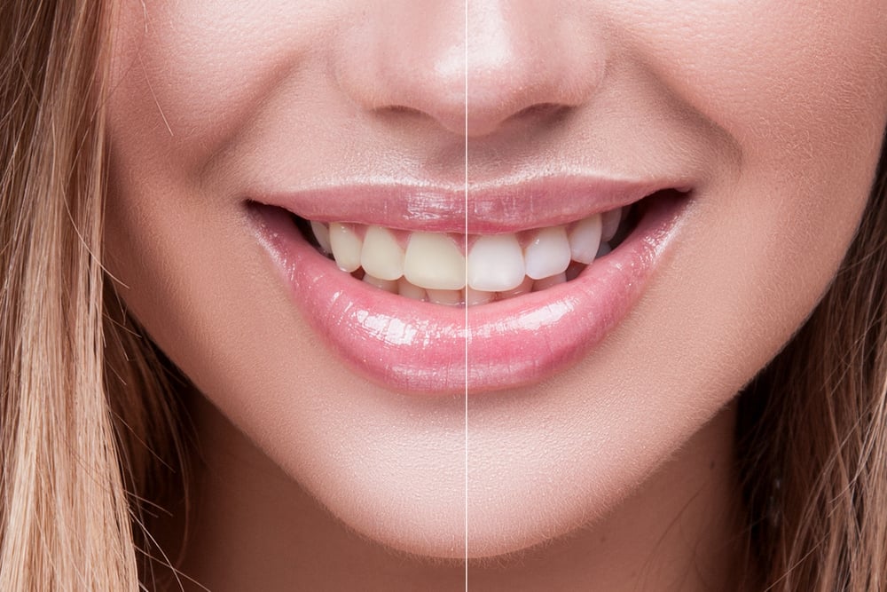 Blanqueamiento dental es seguro y cuándo es recomendable