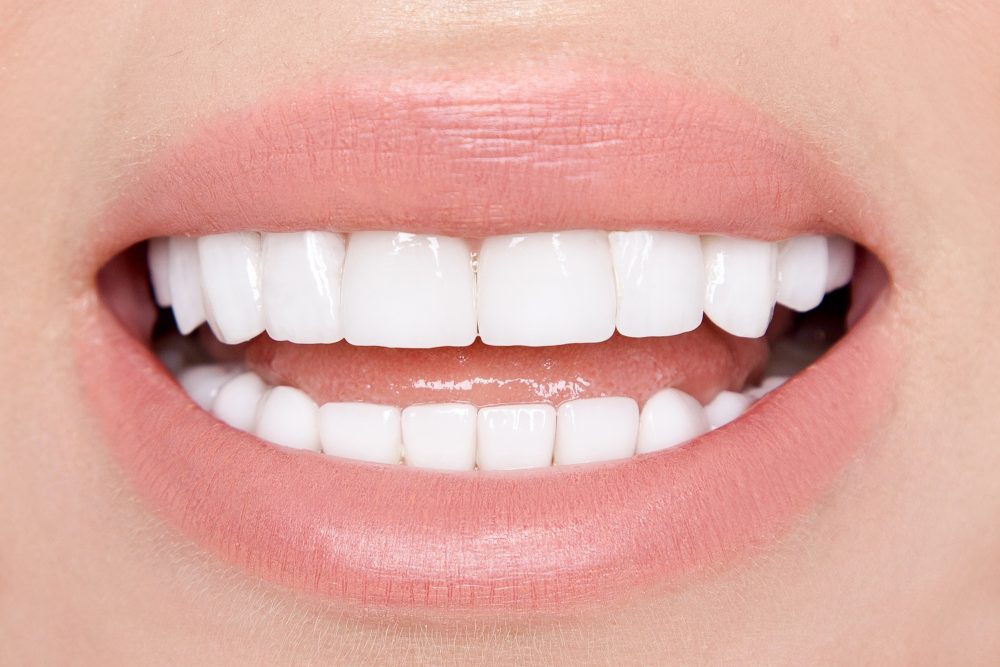 conseguir una sonrisa perfecta sin cirugía