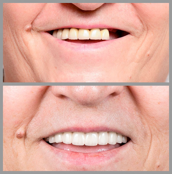 Duele realmente implante dental