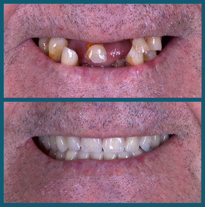 Duele realmente un implante dental