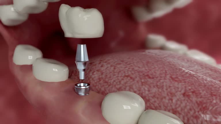 realmente un implante dental duele