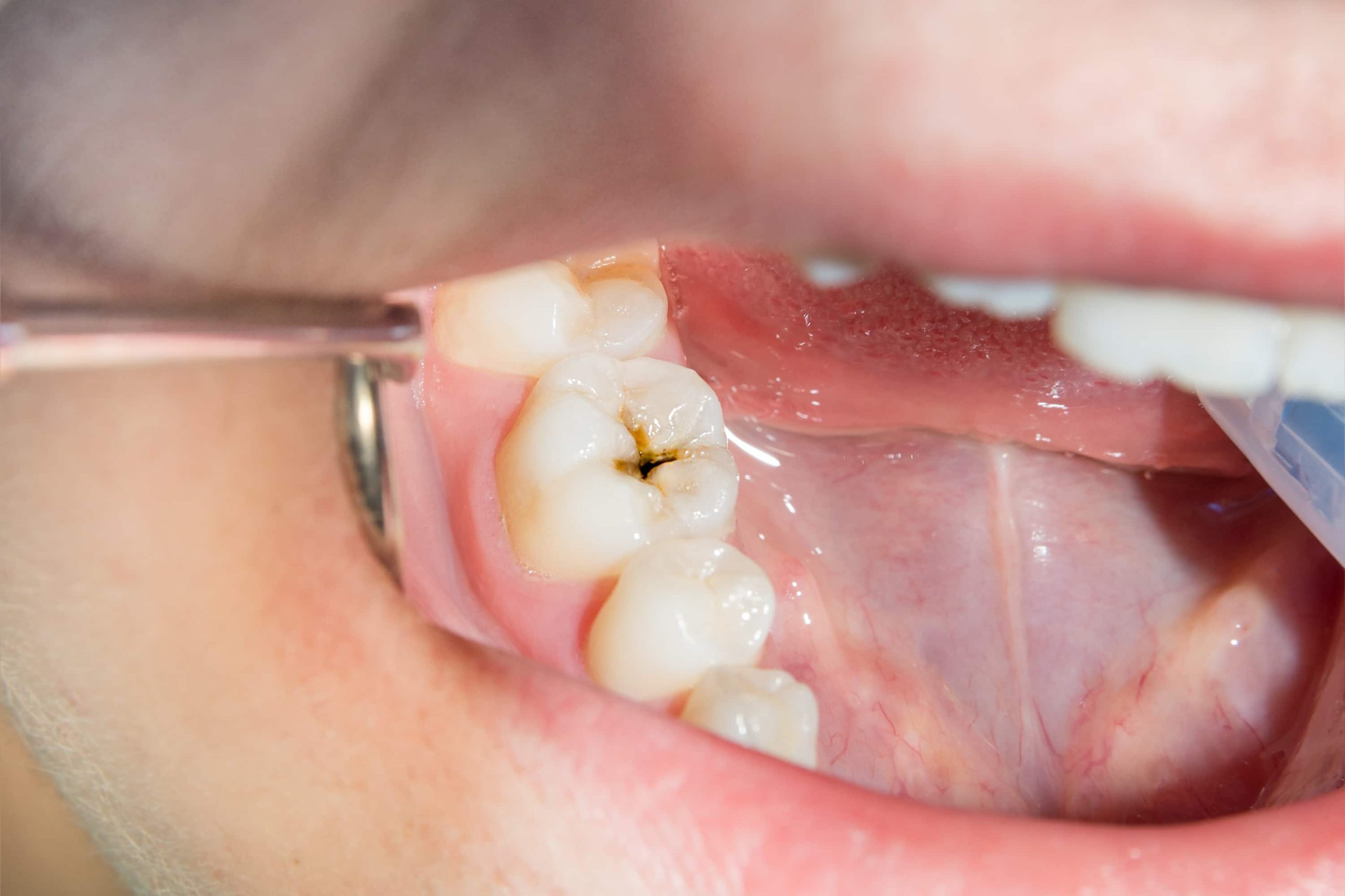 Cómo prevenir las caries de forma efectiva