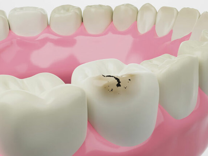 Cómo prevenir las caries forma efectiva